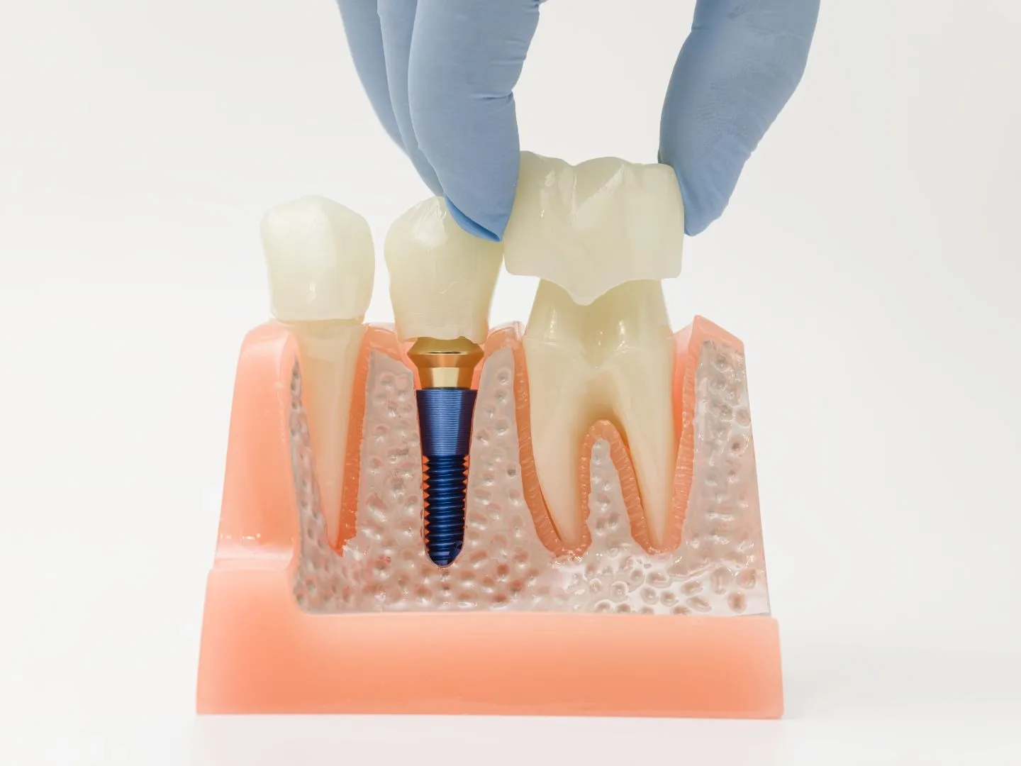 Corona dental de porcelana