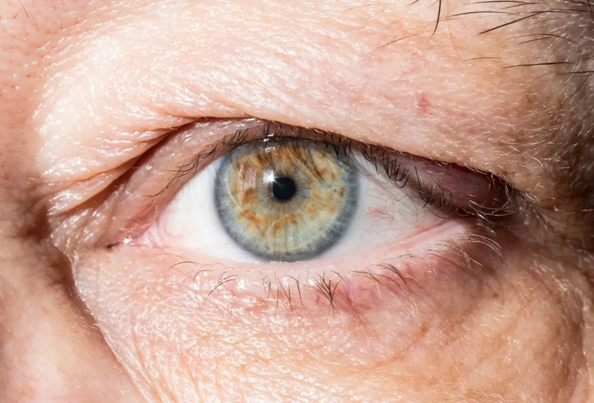 Indicaciones para blefaroplastia - exceso de piel y bolsas