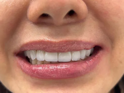 Resultado de carillas cerámicas realizado por la Dra. Carolina Macareno