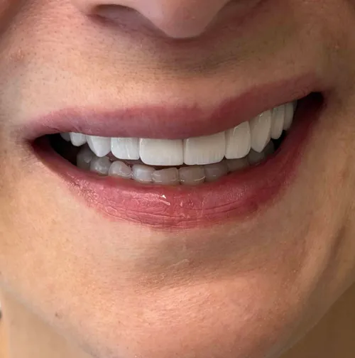 Resultado de diseño de sonrisa en cerámica realizado por la Dra. Carolina Macareno